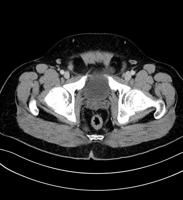Chromophobe renal cell carcinoma (Radiopaedia 84286-99573 G 71).jpg