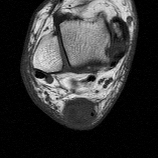 File:Chronic Achilles tendon rupture (Radiopaedia 15262-15100 Axial T1 14).jpg