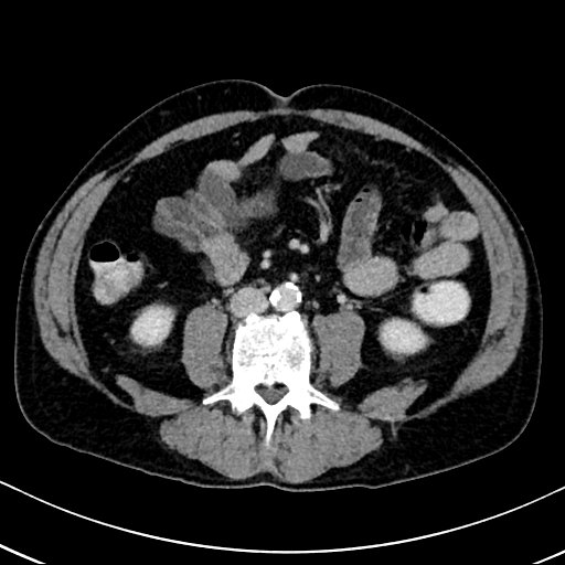Chronic appendicitis complicated by appendicular abscess, pylephlebitis and liver abscess (Radiopaedia 54483-60700 B 87).jpg
