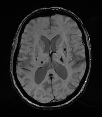 Chronic hypertensive encephalopathy (Radiopaedia 39993-42482 Axial SWI 49).png