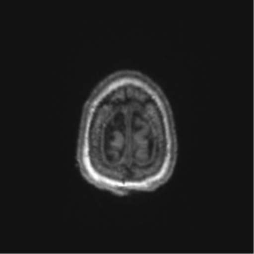 Chronic hypertensive encephalopathy (Radiopaedia 72844-83495 Axial T1 6).png