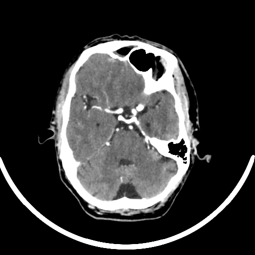 Chronic invasive fungal sinusitis with intraorbital and intracranial extension (Radiopaedia 56387-63046 B 125).jpg