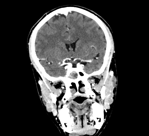 Chronic invasive fungal sinusitis with intraorbital and intracranial extension (Radiopaedia 56387-63046 C 170).jpg