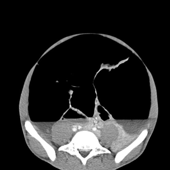Chronic large bowel pseudo-obstruction (Radiopaedia 43181-46492 A 120).jpg