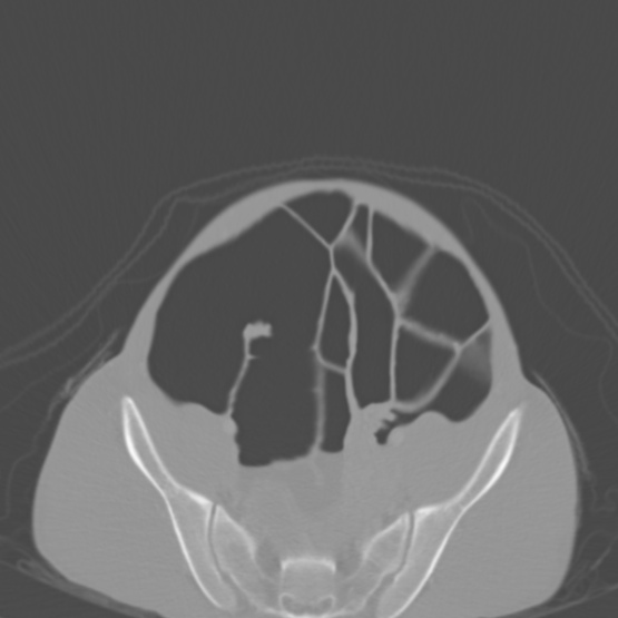 Chronic large bowel pseudo-obstruction (Radiopaedia 43181-46492 Axial bone window 136).jpg