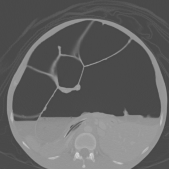 Chronic large bowel pseudo-obstruction (Radiopaedia 43181-46492 Axial bone window 74).jpg