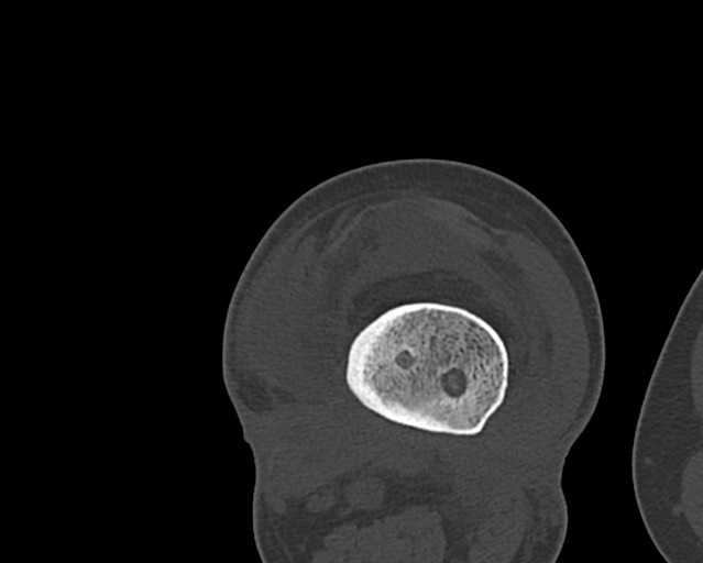 Chronic ostemyelitis of the femur with long sinus tract (Radiopaedia 74947-85982 Axial bone window 178).jpg
