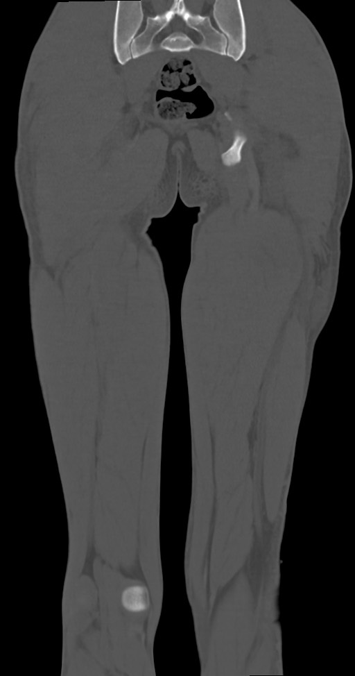 Chronic osteomyelitis (with sequestrum) (Radiopaedia 74813-85822 Coronal non-contrast 44).jpg
