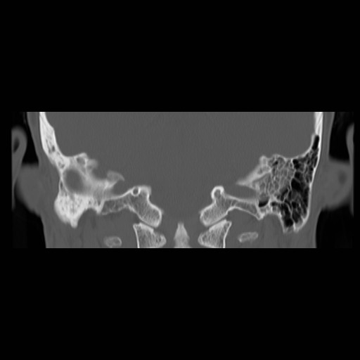 File:Chronic otomastoiditis (Radiopaedia 27138-27309 Coronal bone window 16).jpg