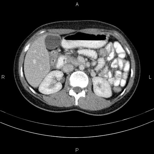 Chronic pancreatitis (Radiopaedia 64576-73450 C 62).jpg