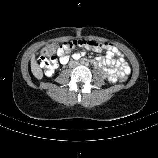 Chronic pancreatitis (Radiopaedia 64576-73450 C 96).jpg