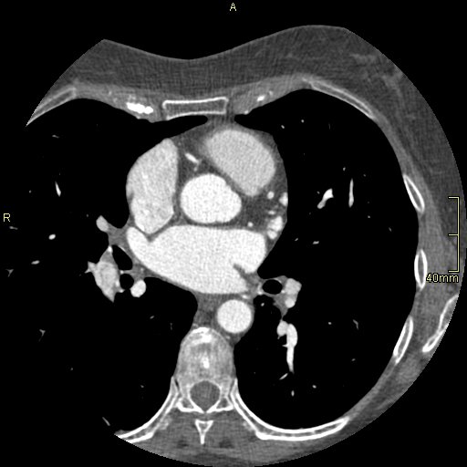 Chronic pulmonary embolism (Radiopaedia 73073-85094 Axial C+ CTPA 80).jpg