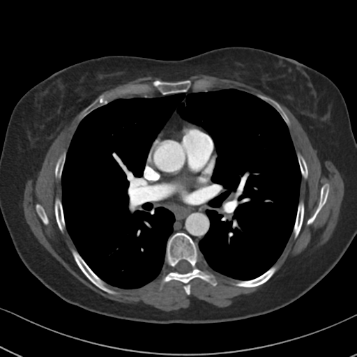 File:Chronic pulmonary embolus (Radiopaedia 39129-41341 Axial C+ CTPA 52).png