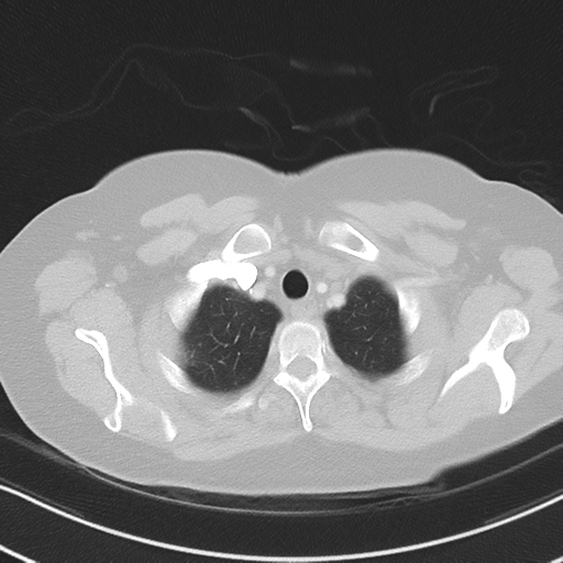 Chronic pulmonary embolus (Radiopaedia 39129-41341 Axial lung window 10).png