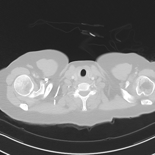 Chronic pulmonary embolus (Radiopaedia 39129-41341 Axial lung window 2).png