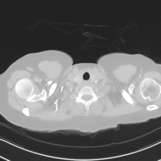 Chronic pulmonary embolus (Radiopaedia 39129-41341 Axial lung window 3).png