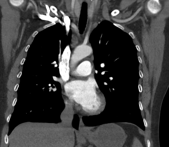 Chronic pulmonary embolus (Radiopaedia 39129-41341 Coronal C+ CTPA 42).png