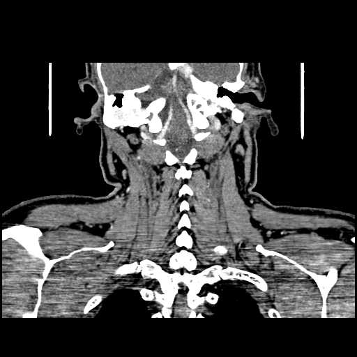 File:Chronic submandibular abscess (Radiopaedia 21738-21718 B 26).jpg
