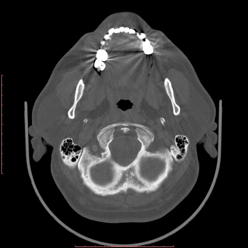 Chronic submandibular sialolithiasis (Radiopaedia 69817-79814 Axial bone window 17).jpg