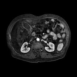 Cirrhosis and hepatocellular carcinoma in the setting of hemochromatosis (Radiopaedia 75394-86594 Axial T1 C+ fat sat 108).jpg