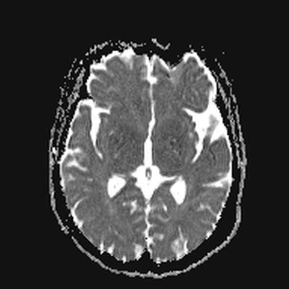 File:Clival meningioma (Radiopaedia 53278-59248 Axial ADC 12).jpg