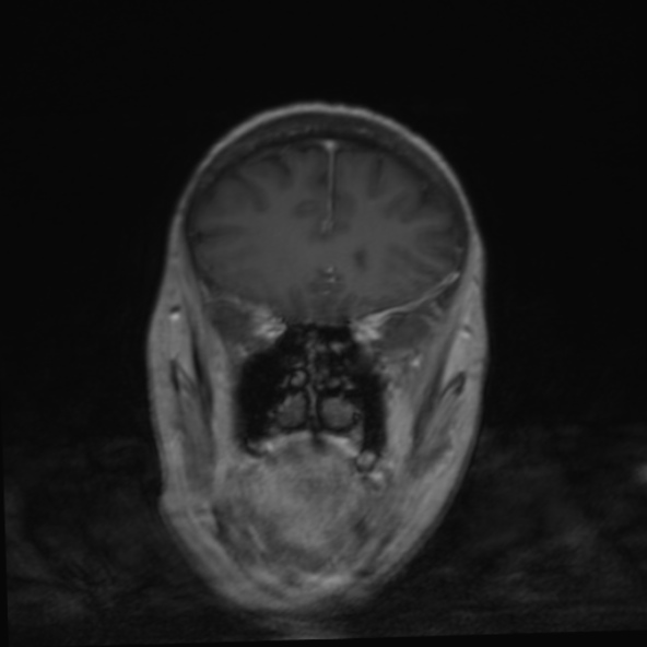 File:Clival meningioma (Radiopaedia 53278-59248 F 9).jpg