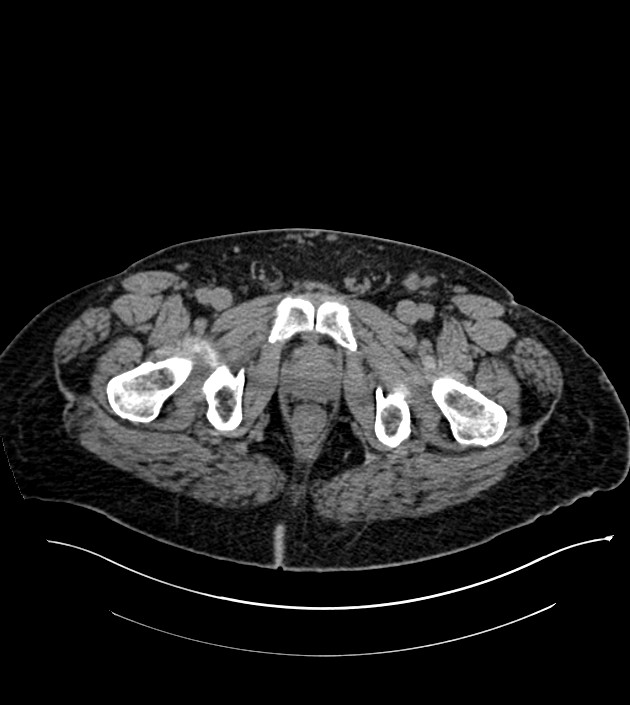 Closed-loop small bowel obstruction-internal hernia (Radiopaedia 78439-91096 Axial non-contrast 156).jpg