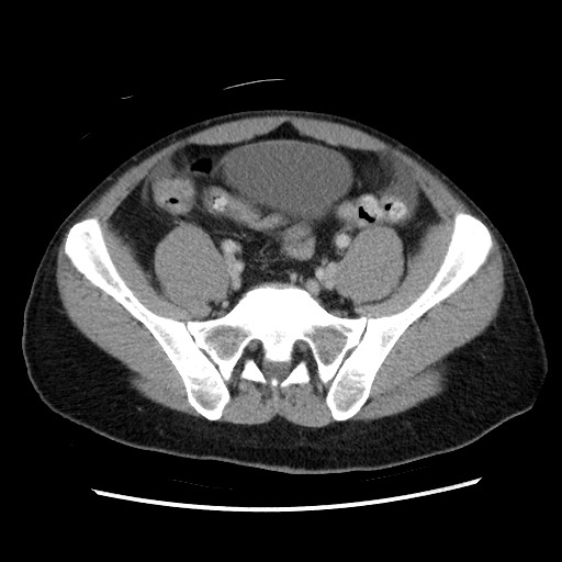 File:Closed-loop small bowel obstruction (Radiopaedia 73713-84509 A 125).jpg