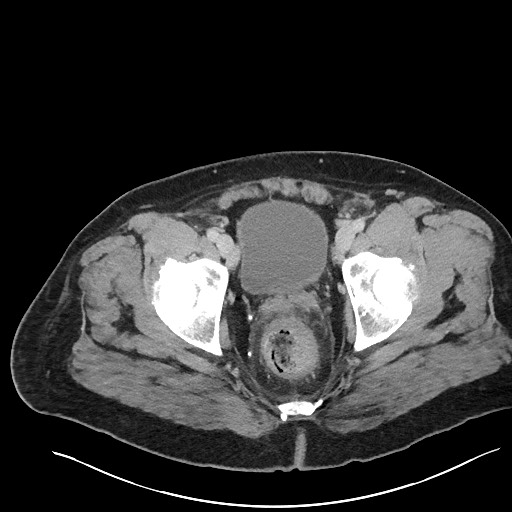 File:Closed loop obstruction - internal hernia into nephrectomy bed (Radiopaedia 59867-67320 A 133).jpg