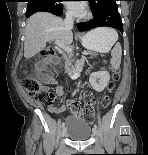 File:Closed loop obstruction - internal hernia into nephrectomy bed (Radiopaedia 59867-67320 B 66).jpg