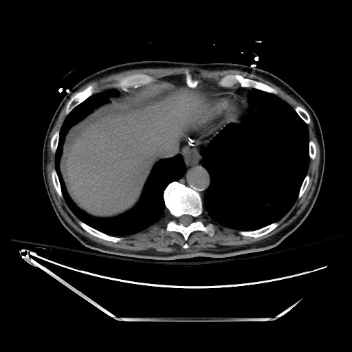 Closed loop obstruction due to adhesive band, resulting in small bowel ischemia and resection (Radiopaedia 83835-99023 Axial non-contrast 23).jpg