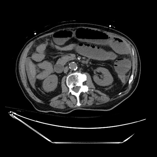 Closed loop obstruction due to adhesive band, resulting in small bowel ischemia and resection (Radiopaedia 83835-99023 Axial non-contrast 67).jpg