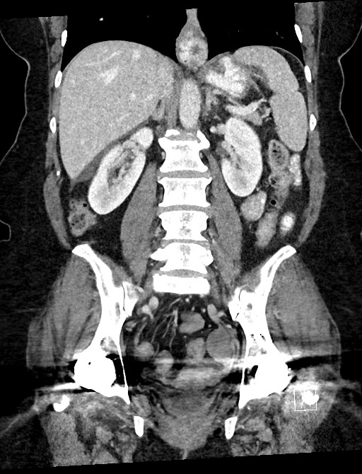 Closed loop small bowel obstruction - adhesions (Radiopaedia 59078-66369 B 75).jpg