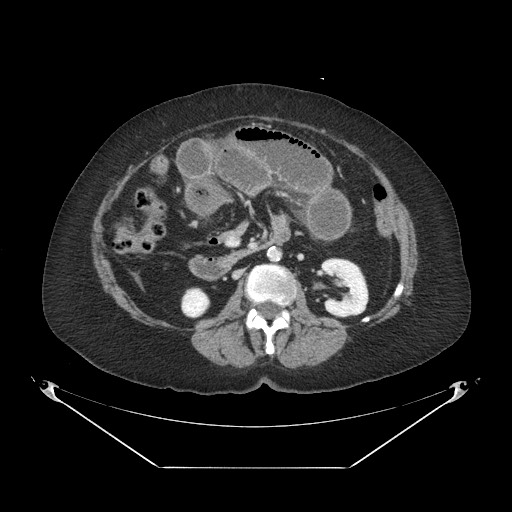 Closed loop small bowel obstruction - internal hernia (Radiopaedia 65402-74450 A 58).jpg