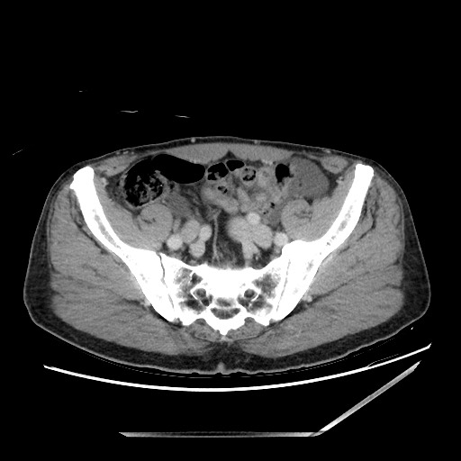 Closed loop small bowel obstruction - omental adhesion causing "internal hernia" (Radiopaedia 85129-100682 A 131).jpg
