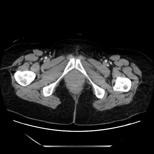 File:Closed loop small bowel obstruction due to adhesive bands - early and late images (Radiopaedia 83830-99014 A 166).jpg