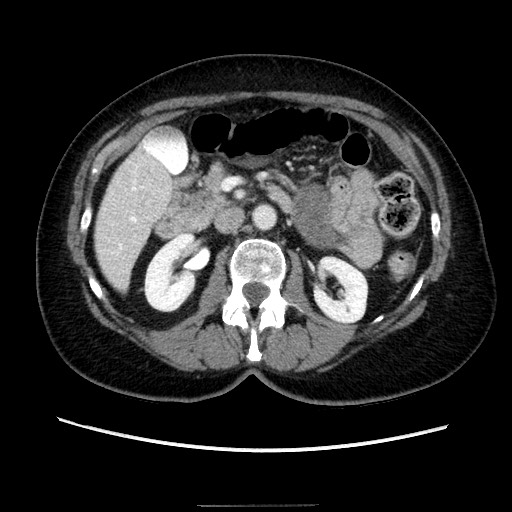 Closed loop small bowel obstruction due to adhesive bands - early and late images (Radiopaedia 83830-99015 A 62).jpg