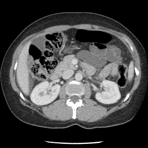File:Closed loop small bowel obstruction due to trans-omental herniation (Radiopaedia 35593-37109 A 35).jpg