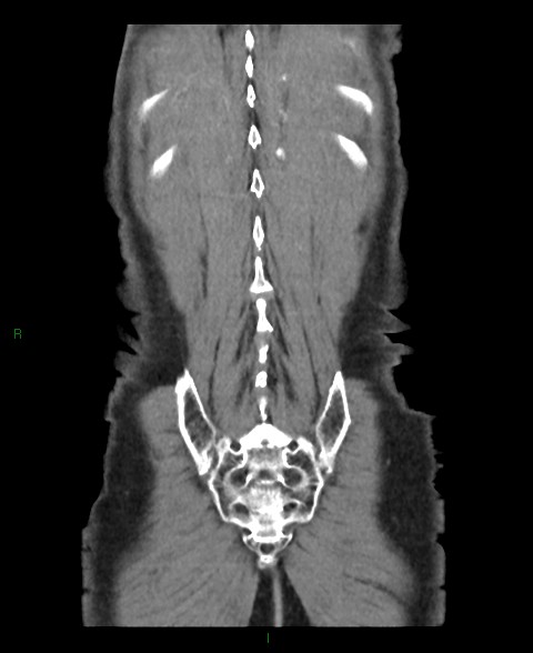 File:Closed loop small bowel obstruction with ischemia (Radiopaedia 84180-99456 B 4).jpg