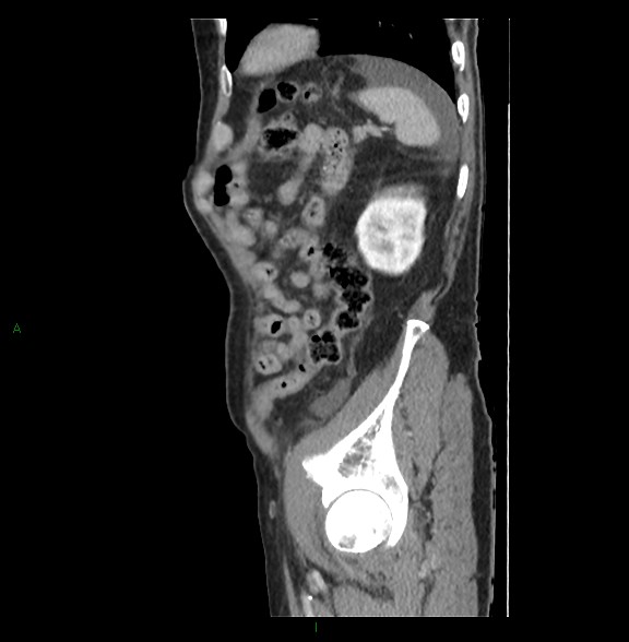 Closed loop small bowel obstruction with ischemia (Radiopaedia 84180-99456 C 74).jpg