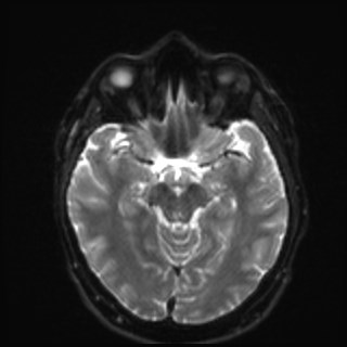 Cochlear incomplete partition type III associated with hypothalamic hamartoma (Radiopaedia 88756-105498 Axial DWI 17).jpg
