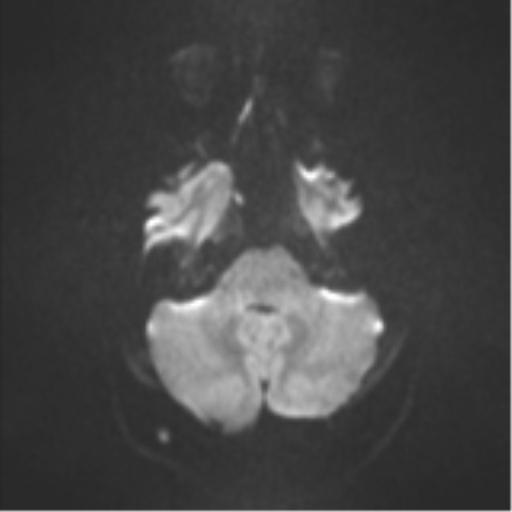Colloid cyst (Radiopaedia 53164-59125 Axial DWI 34).png