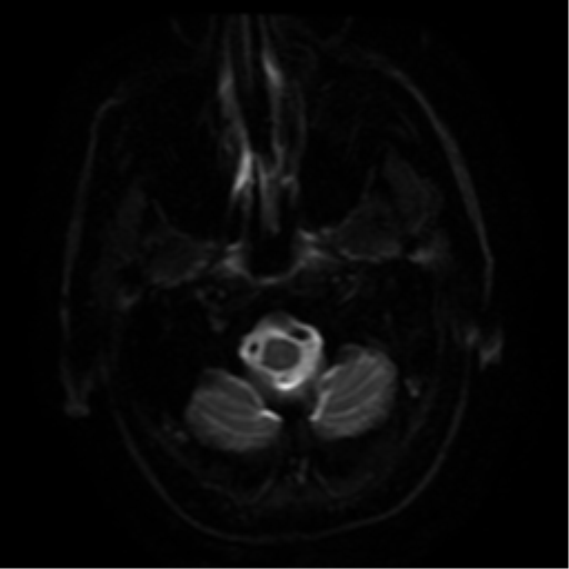 File:Colloid cyst (large) (Radiopaedia 34415-35729 Axial DWI 23).png