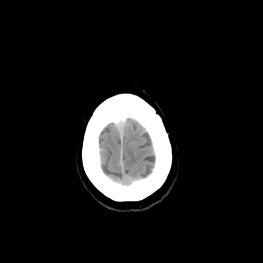 File:Colloid cyst (large) (Radiopaedia 34415-35734 Axial non-contrast 53).png