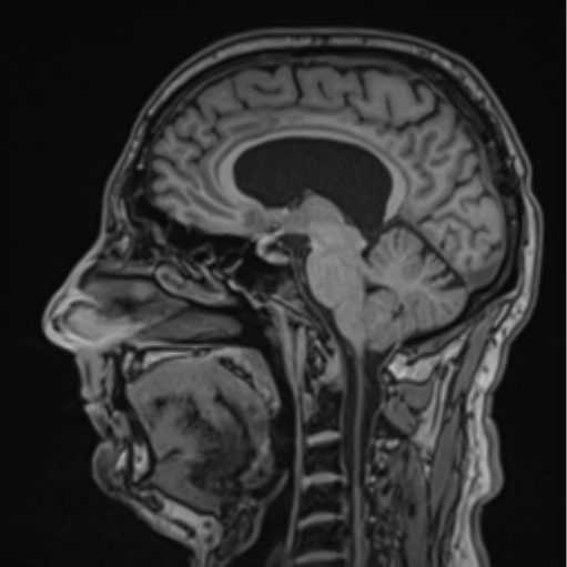 File:Colloid cyst of the third ventricle (Radiopaedia 86571-102662 Sagittal T1 42).png