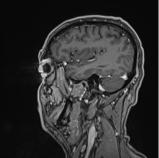 File:Colloid cyst of the third ventricle (Radiopaedia 86571-102662 Sagittal T1 C+ 60).png