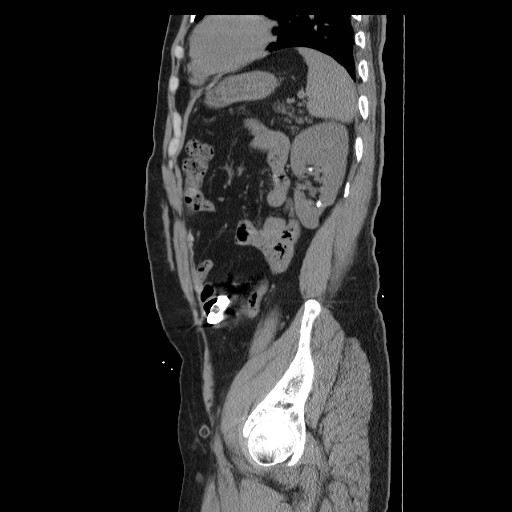 Colocutaneous fistula in Crohn's disease (Radiopaedia 29586-30093 F 39).jpg
