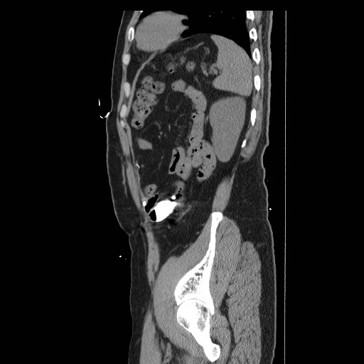 Colocutaneous fistula in Crohn's disease (Radiopaedia 29586-30093 F 42).jpg