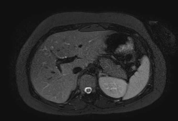 Colon adenocarcinoma with Krukenberg tumors, advanced pregnancy (Radiopaedia 67279-76645 Axial T2 SPAIR 65).jpg