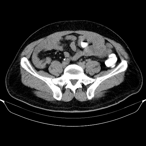 Colonic lipoma with colo-colic intussusception (Radiopaedia 58944-66200 Axial C+ rectal 49).jpg
